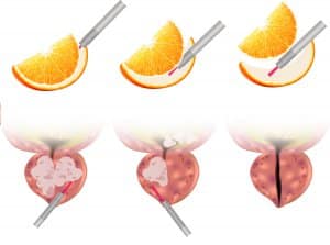 HoLEP procedure image